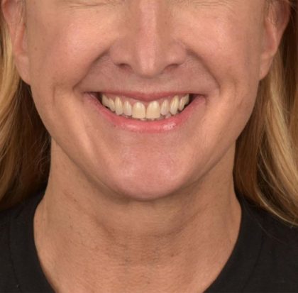 Neck Lift Before & After Patient #3666