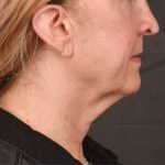 Neck Lift Before & After Patient #3666