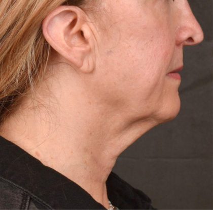 Neck Lift Before & After Patient #3666