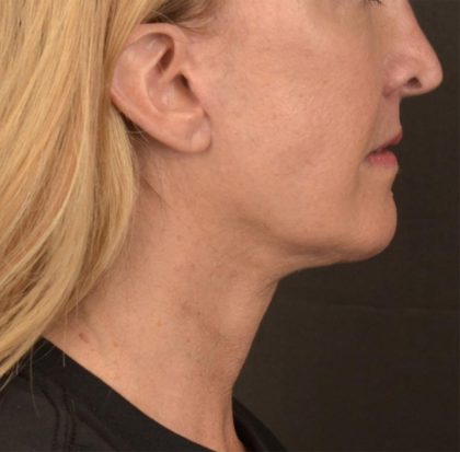 Neck Lift Before & After Patient #3666