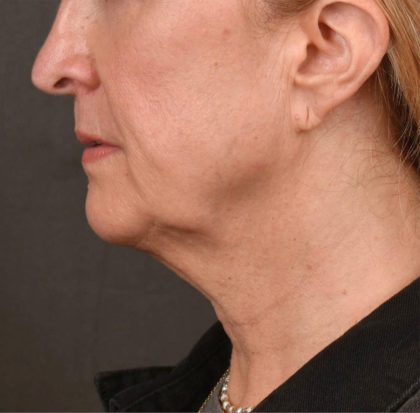 Neck Lift Before & After Patient #3666