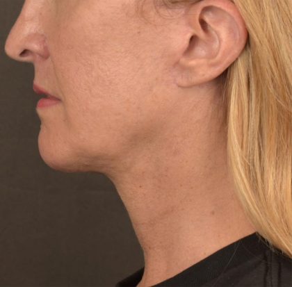 Neck Lift Before & After Patient #3666