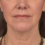 Neck Lift Before & After Patient #3657