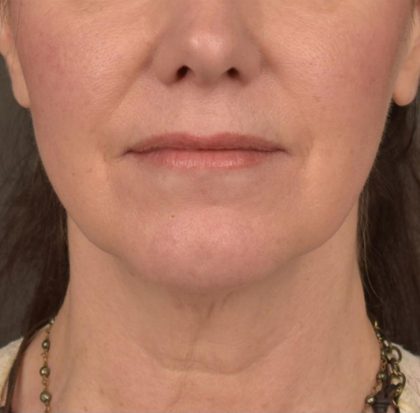 Neck Lift Before & After Patient #3657