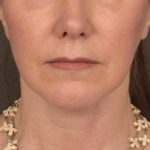Neck Lift Before & After Patient #3657