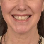 Neck Lift Before & After Patient #3657