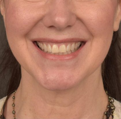 Neck Lift Before & After Patient #3657
