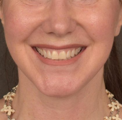 Neck Lift Before & After Patient #3657