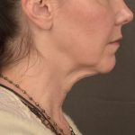 Neck Lift Before & After Patient #3657
