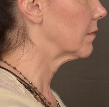 Neck Lift Before & After Patient #3657