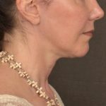 Neck Lift Before & After Patient #3657