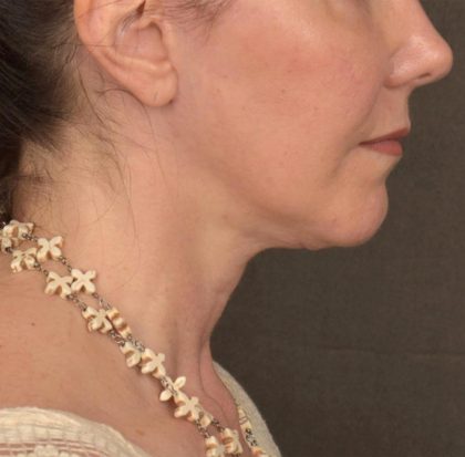 Neck Lift Before & After Patient #3657
