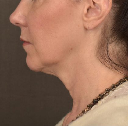 Neck Lift Before & After Patient #3657