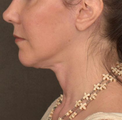 Neck Lift Before & After Patient #3657