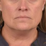Neck Lift Before & After Patient #3658