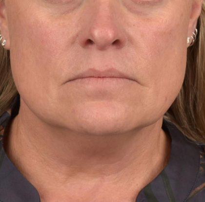 Neck Lift Before & After Patient #3658