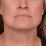 Neck Lift Before & After Patient #3658
