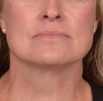 Neck Lift Before & After Patient #3658