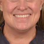 Neck Lift Before & After Patient #3658
