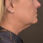 Neck Lift Before & After Patient #3658