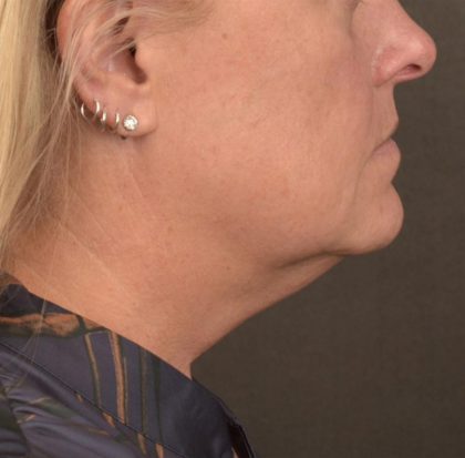 Neck Lift Before & After Patient #3658
