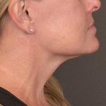 Neck Lift Before & After Patient #3658