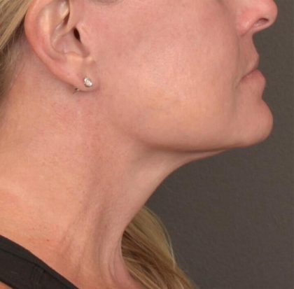 Neck Lift Before & After Patient #3658
