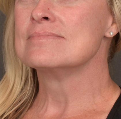 Neck Lift Before & After Patient #3658