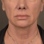 Neck Lift Before & After Patient #3656