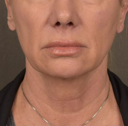 Neck Lift Before & After Patient #3656