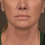 Neck Lift Before & After Patient #3656