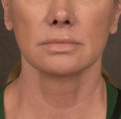 Neck Lift Before & After Patient #3656