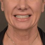 Neck Lift Before & After Patient #3656