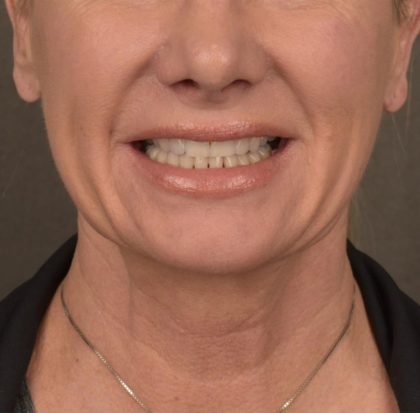 Neck Lift Before & After Patient #3656