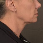 Neck Lift Before & After Patient #3656