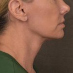 Neck Lift Before & After Patient #3656