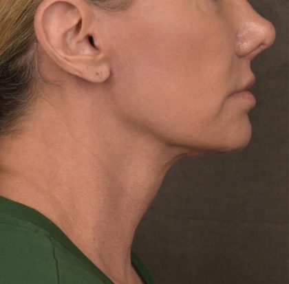 Neck Lift Before & After Patient #3656