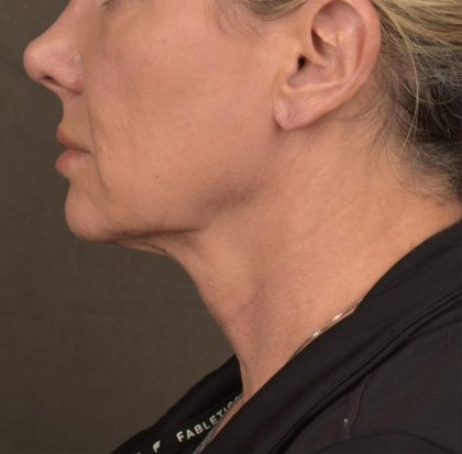 Neck Lift Before & After Patient #3656