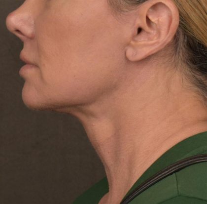Neck Lift Before & After Patient #3656
