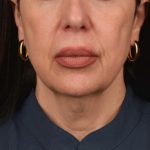 Neck Lift Before & After Patient #3655