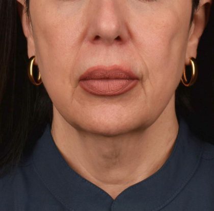Neck Lift Before & After Patient #3655