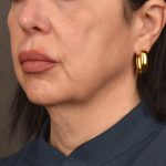 Neck Lift Before & After Patient #3655