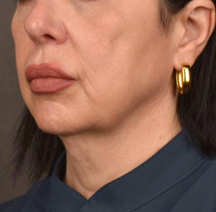Neck Lift Before & After Patient #3655