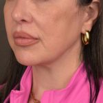 Neck Lift Before & After Patient #3655