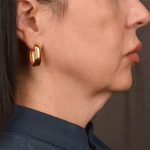 Neck Lift Before & After Patient #3655