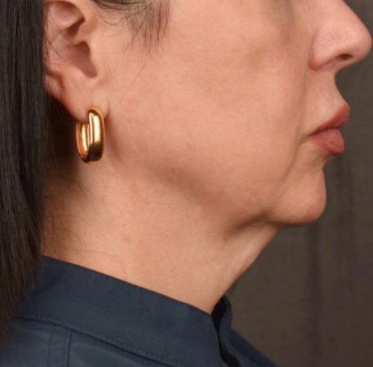 Neck Lift Before & After Patient #3655
