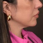 Neck Lift Before & After Patient #3655