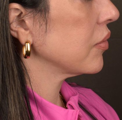 Neck Lift Before & After Patient #3655