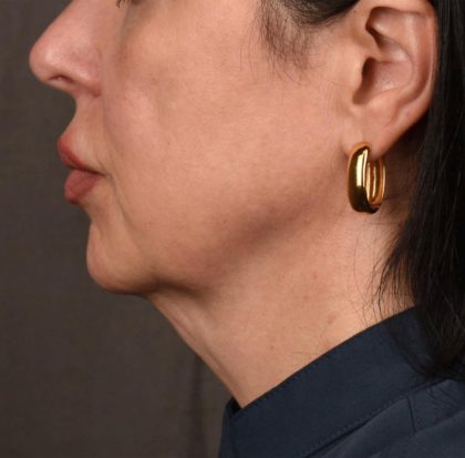 Neck Lift Before & After Patient #3655