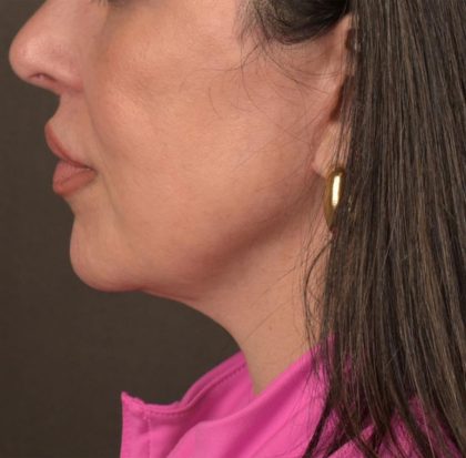 Neck Lift Before & After Patient #3655